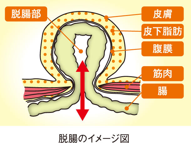 脱腸のイメージ図