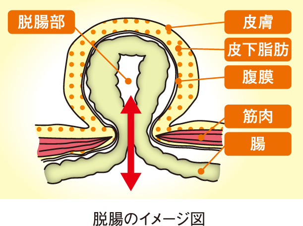 脱腸 放置 すると